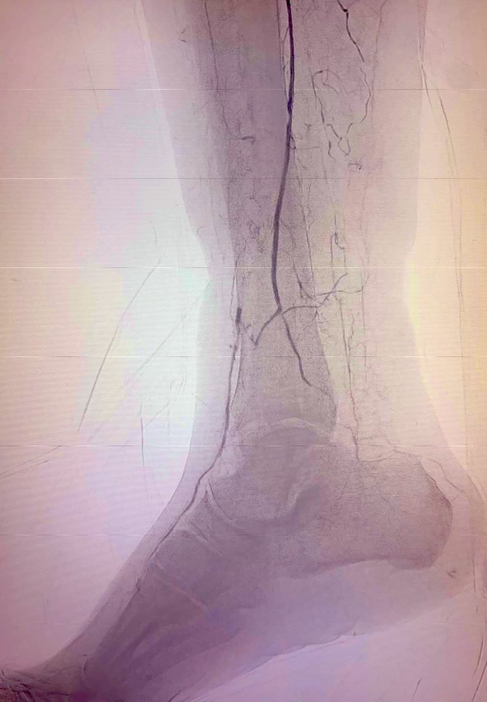 erikstilp's tweet photo. R5 CLI. Toe Pressure 0. Recent endocarditis required pacer removal.  Needs reimplant for Type2 block but not w open wound. GFR 42. Plan?  @CLIFighters @CarlosMenaYale @SJcardio @kmadass @SriniTummala @DrPatGeraghty @AllaqabanSuhail https://t.co/4hhqfwrLwD