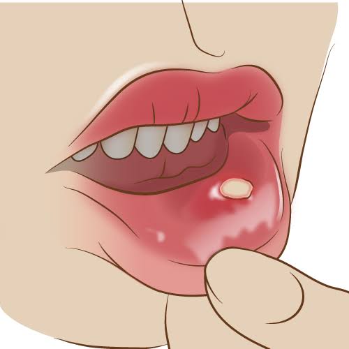 健康マスター トシユキ 痛い口内炎の超回復方法 注意 とてつもなく激痛です 何年か前に私がやった方法で信じられないほど早く回復しました 粉末のクエン酸を口内炎に直接塗る 楊枝で口内炎を刺しているかのような激痛が走ります ドmな方は