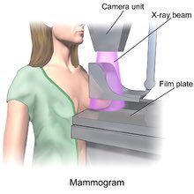 DIAGNOSIS- if an individual is already presenting with symptoms, tests are done to determine if it is indeed breast ca. -mammogram or breast ultrasound is done after you’re examined by a Dr or nurse. The ultrasound is used for those less than 35yrs in addition to the mammogram