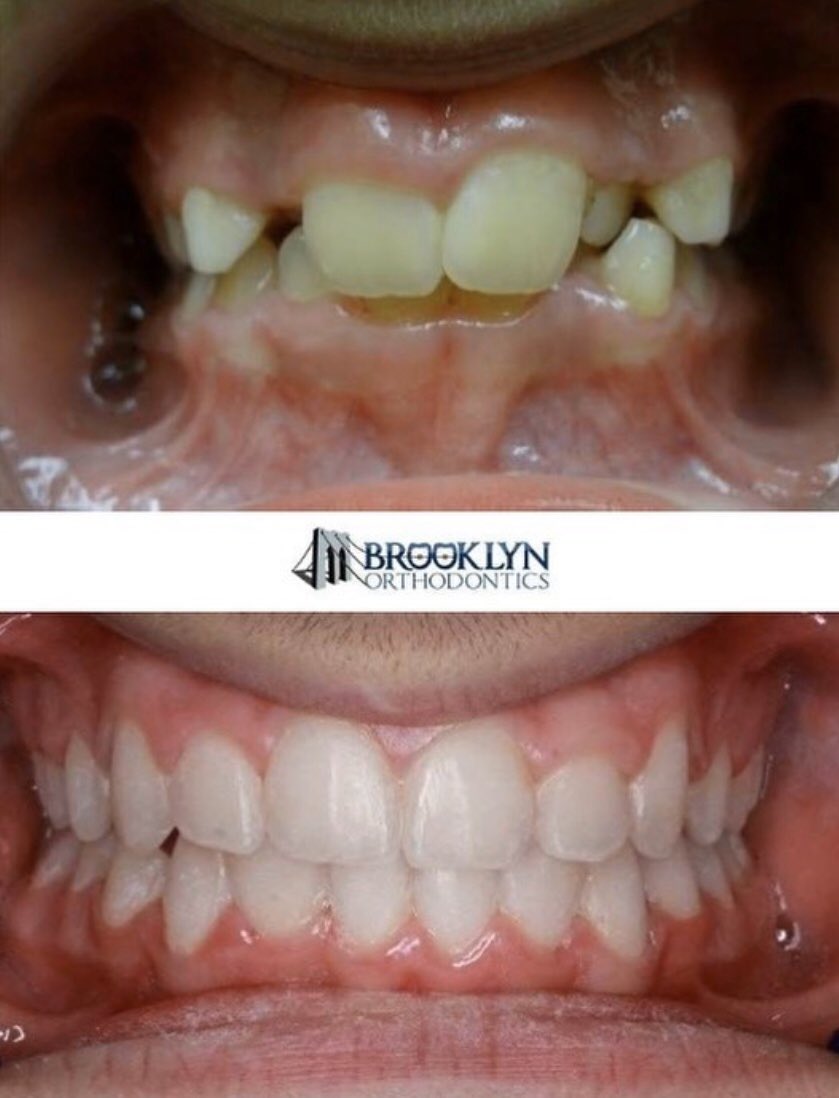 Here is a quick before and after 
By yours truly!!
😍😍❤️🦷