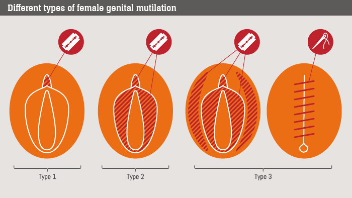 MokgageComm3724's tweet photo. FGM is classified into 4 types:

𝗧𝘆𝗽𝗲 𝗜: aka the clitoridectomy 
𝗧𝘆𝗽𝗲 𝗜𝗜: aka the excision
𝗧𝘆𝗽𝗲 𝗜𝗜𝗜: the most severe forms aka the infibulation or pharaonic type
𝗧𝘆𝗽𝗲 𝗜𝗩: all other procedures such as pricking, piercing, incising, scraping and cauterization https://t.co/svgAUerm2V