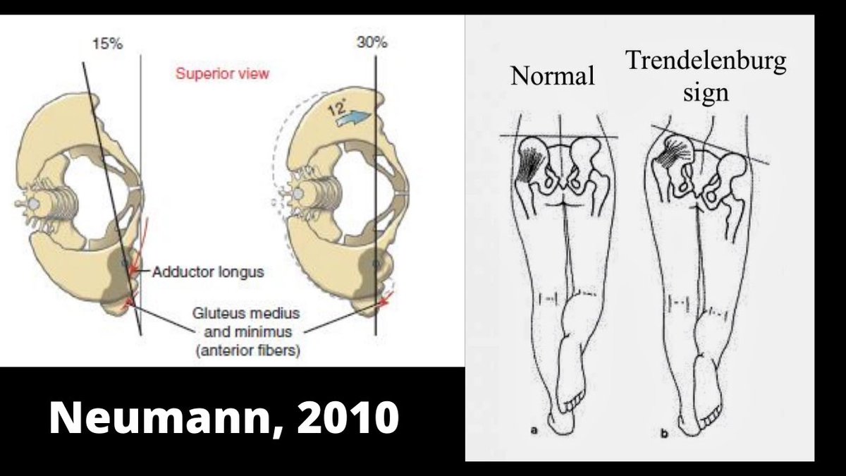Without adequate support from the glute med, the pelvis and trunk likely drop uncontrollably toward the side of the swinging limb.This often results in what is called a Trendelenbrug Sign.