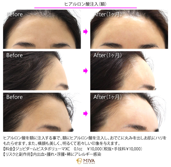 Miyaフェイスクリニック ヒアルロン酸 の注入系プチ整形は 施術後すぐに効果を感じ 施術時間も短くダウンタイムもほとんどない人気の施術です Miyaメソッドで お一人お一人のお悩みに対し最適な治療をご提案します T Co K1kodbpbor 宮里 Miyaフェイスクリニック ヒアルロン酸 の注入系プチ整形は 施術後すぐに効果を感じ 施術時間も短くダウンタイムもほとんどない人気の施術です Miyaメソッドで お一人お一人のお悩みに対し最適な治療をご提案します T Co K1kodbpbor 宮里