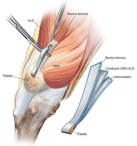(5/5). Quadriceps Tendon Autograft:* Less commonly used* Predictable graft size; thicker* Small incision* Less graft site & anterior knee pain* Shown in recent study to have higher failure rate