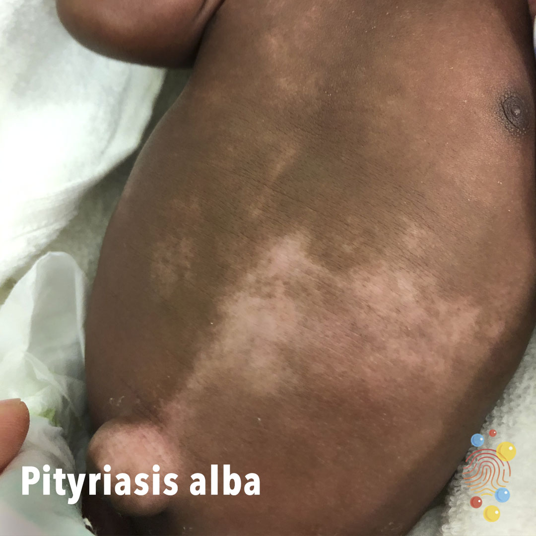DFTBSkinDeep's tweet photo. A type of eczema/dermatitis found in children. It's often found after sun exposure (patches are more prominent).

Image shows scattered patches of hypopigmentation with indistinct margins on abdomen.

https://t.co/BozNzlDDxP
@HealthySkin4All@EczemaAu@eczemasociety@nationaleczema https://t.co/PfcGRlFM4r