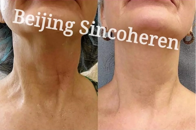 damowanggg's tweet photo. #4d HIFU machine
#4dhifu #hifu #hifutreatment #facelifting #necklifting
#antiaging #wrinkleremoval #skin #skintightening 
#skinrejuvenation #facialrelaxation
☎️Whatsapp:0086 15503022871 https://t.co/jf1wqwGdhL