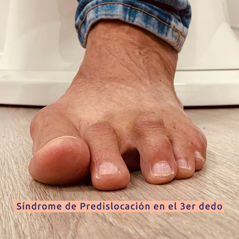 Fixtoe's tweet photo. 📢Case of Dr.@raulrabla,partner of @Podoactiva. Predislocation Syndrome in the 3ºtoe and IPK in the 3ºMetatarsal. Pre&amp;postoperative photos at 29 days, after the intervention MIS osteotomy in the 3ºMetatarsal and double osteotomy in the 3ºtoe + Fixtoe Pro to stabilize the surgery. https://t.co/Iz4hUjFwpu