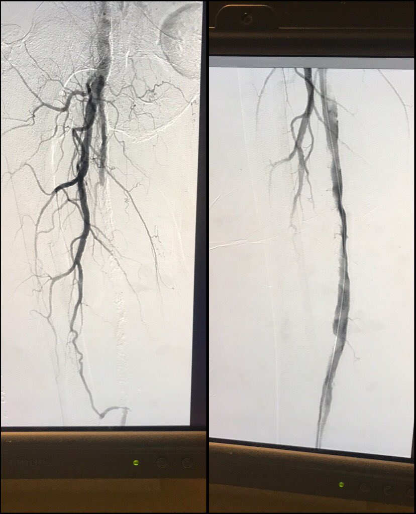 UjjwalRastogiMD's tweet photo. @drmoinlala @heartdoc45 @AmitAmin13 @heartdoc101 @nayanagarwal85 @natrajkatta24 @dr_ashishg @t_intheleadcoat @SriniTummala @dandu_n Finished this case yesterday with 0.035 glide and #quickcross and #CSI @csi360. Got descent result. Flow to the foot is better with PT and Peroneal getting flow. Seems most folks are ok going retro with single vessel runoff ? https://t.co/XT5GgP7IJi