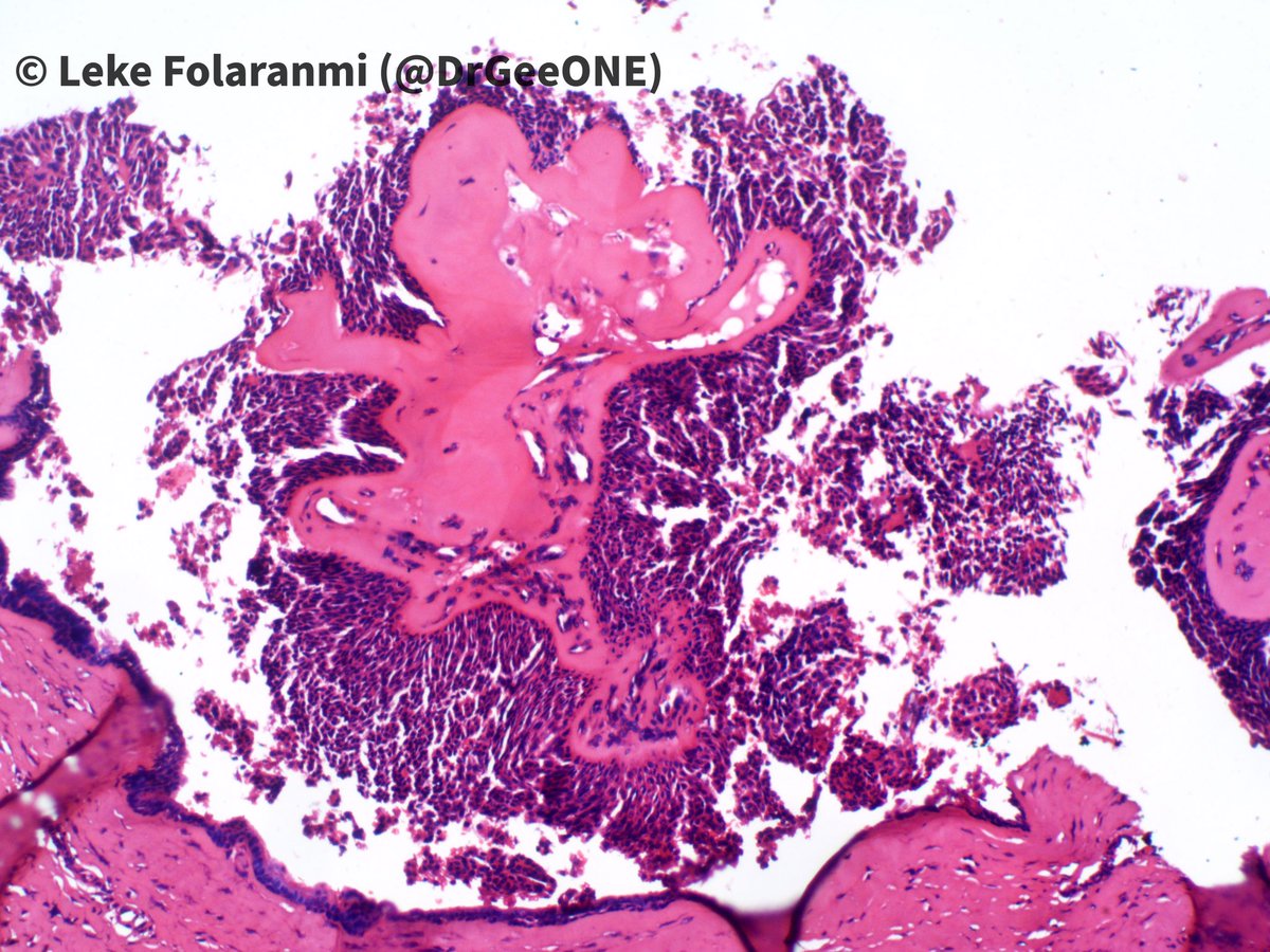 1/2 Nodular finger mass in a young female.Duration: 2 yearsI’m torn between 2 worlds: Nodular/cystic hidradenoma vs Aggressive Digital Papillary Adenocarcinoma. What are your thoughts? #Dermpath