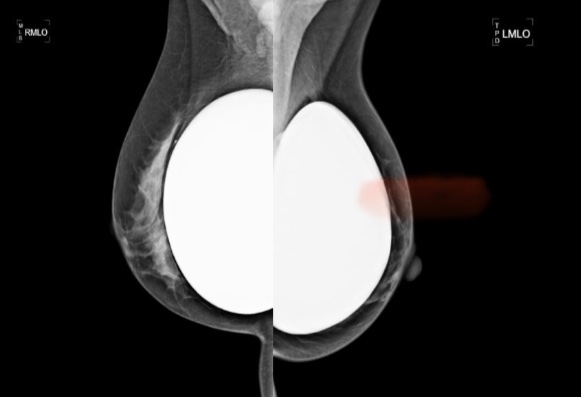 Women with implants can be screened We will use a  technique known as the EKLUND  technique . 

Women may worry that the mammogram can damage their implants,  only minimal pressure is used and there is currently no evidence that it can cause rupture. 

gov.uk/government/pub…