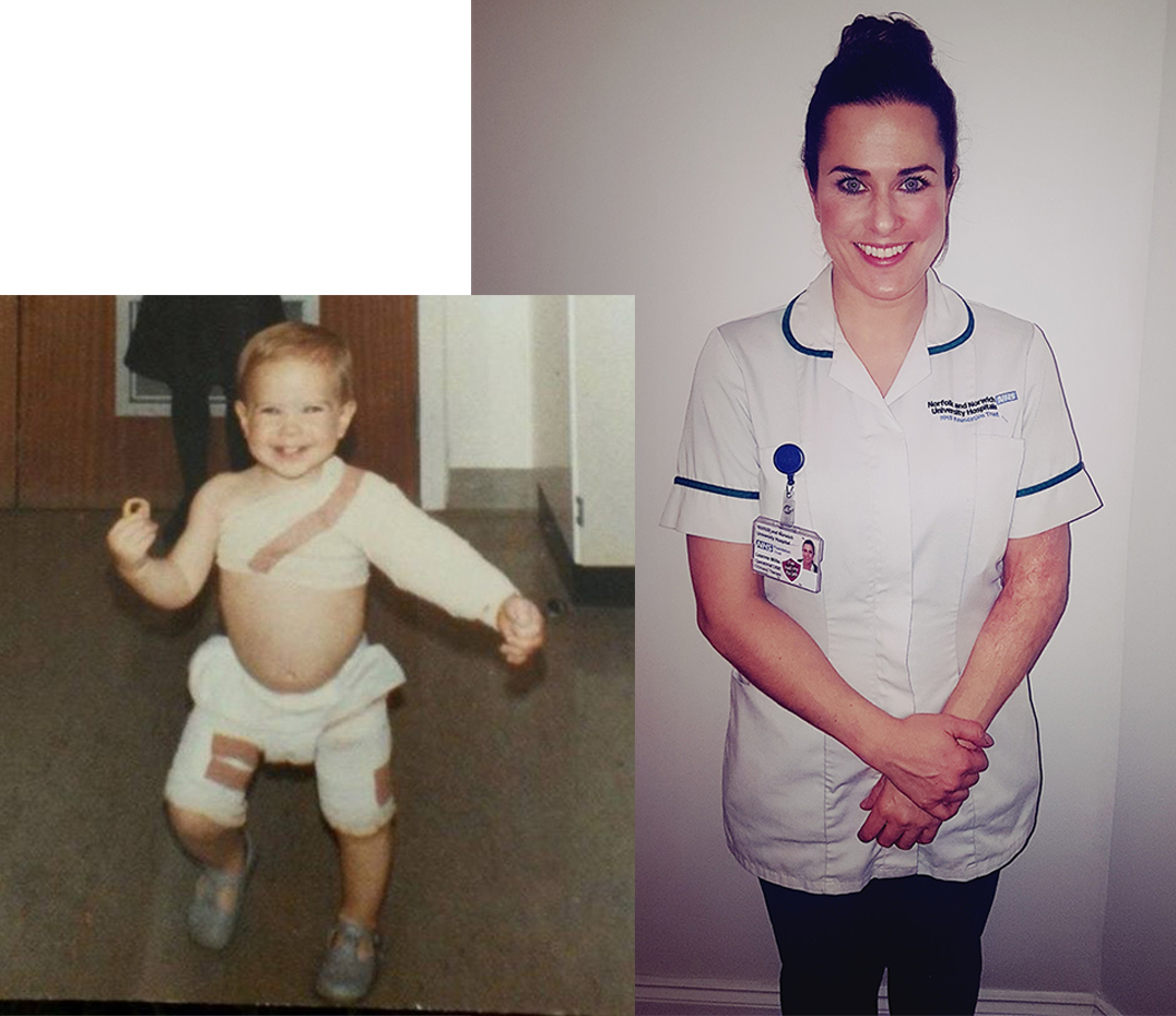 NNUH's tweet photo. As part of Occupational Therapy Week, Leanne Miller shares her personal story of how a serious accident when she was a child and the rehabilitation she received to recover and come to terms with her scars led to her becoming an OT at NNUH #ChooseOT 👇

https://t.co/7S0illrK81 https://t.co/alpjCkeREI