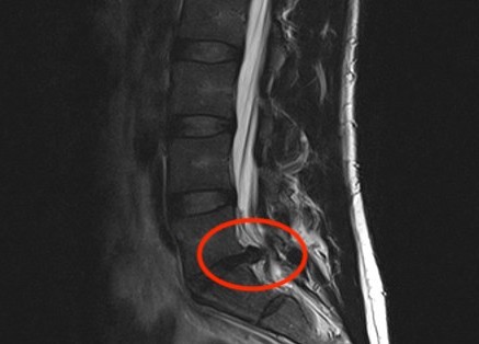 nikolaposa's tweet photo. I ruined my lower back, big time. MRI is showing disc herniation.

I know it sounds like a cliché, but really – avoiding sitting for too long, walk, exercise. Any extra time spent at the computer is just not worth it, in fact it hurts as hell. https://t.co/0dhg4hvkIf
