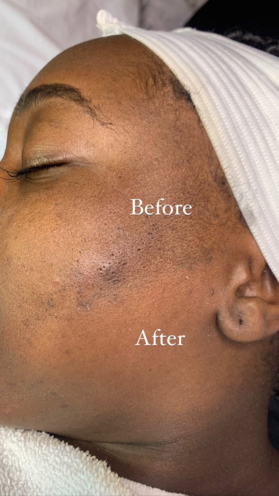 RoyalEstheticz's tweet photo. We are now offering Dermaplaning Facials✨

Dermaplaning is a form of exfoliating your dead skin and removing vellus hair "peach fuzz".

Dermaplaning can be used for any skin type and anyone with acne scars.

https://t.co/DibKBVcmcZ

#SouthernNotState #Statesboro https://t.co/dKeU0HlGg1
