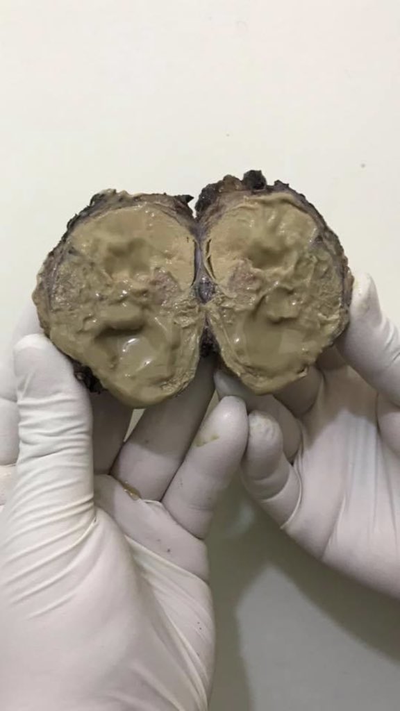 walidaudi4's tweet photo. Parotid gland #warthin tumor https://t.co/NzYAHkBs4N