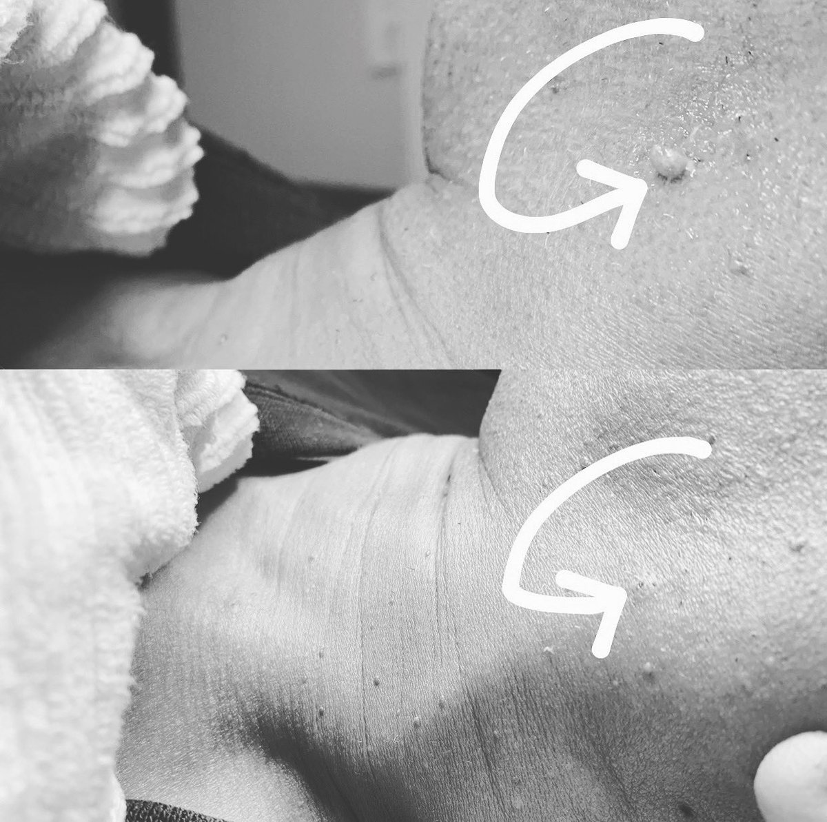 electrolysisllc's tweet photo. 🙋🏻‍♀️Got Skin Tags?? I can help!! 🤓
Electrolysis is a quick, easy and effective method of skin tag removal and is safe to use in all areas. #callme #electrolysis #electrologist #electrology #itworks #beauty #skincare #skin #skintagremoval #skintagsremoval #skintags #skintag https://t.co/6NUMlauYsZ