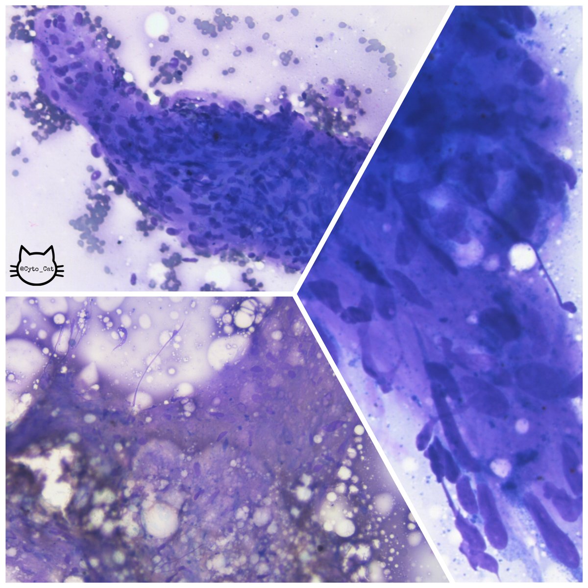 USFpathology's tweet image. M/60s, 2.2cm well circumscribed soft tissue mass found during workup of L shoulder rotator cuff tear. Mass remained grossly stable for years. Patient is otherwise asymptomatic. #cytopath #histology #PathTwitter #pathology #MedTwitter