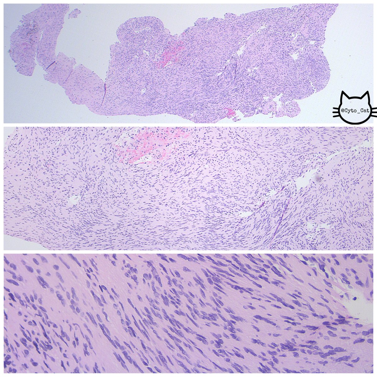 USFpathology's tweet image. M/60s, 2.2cm well circumscribed soft tissue mass found during workup of L shoulder rotator cuff tear. Mass remained grossly stable for years. Patient is otherwise asymptomatic. #cytopath #histology #PathTwitter #pathology #MedTwitter