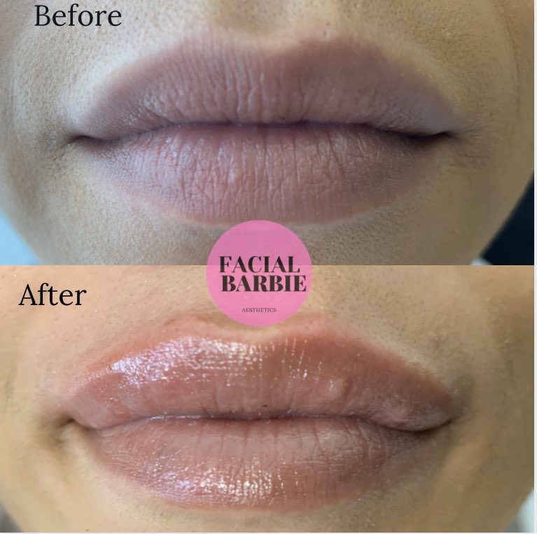 We are absolutely in love with these lips and our new service. 😻 we focused on correcting the top lip and giving more volume to them.  #atlinjector #atlantalipinjections #atlantaneedlelessinjections #atlantlipplumper #atlantalipfillers