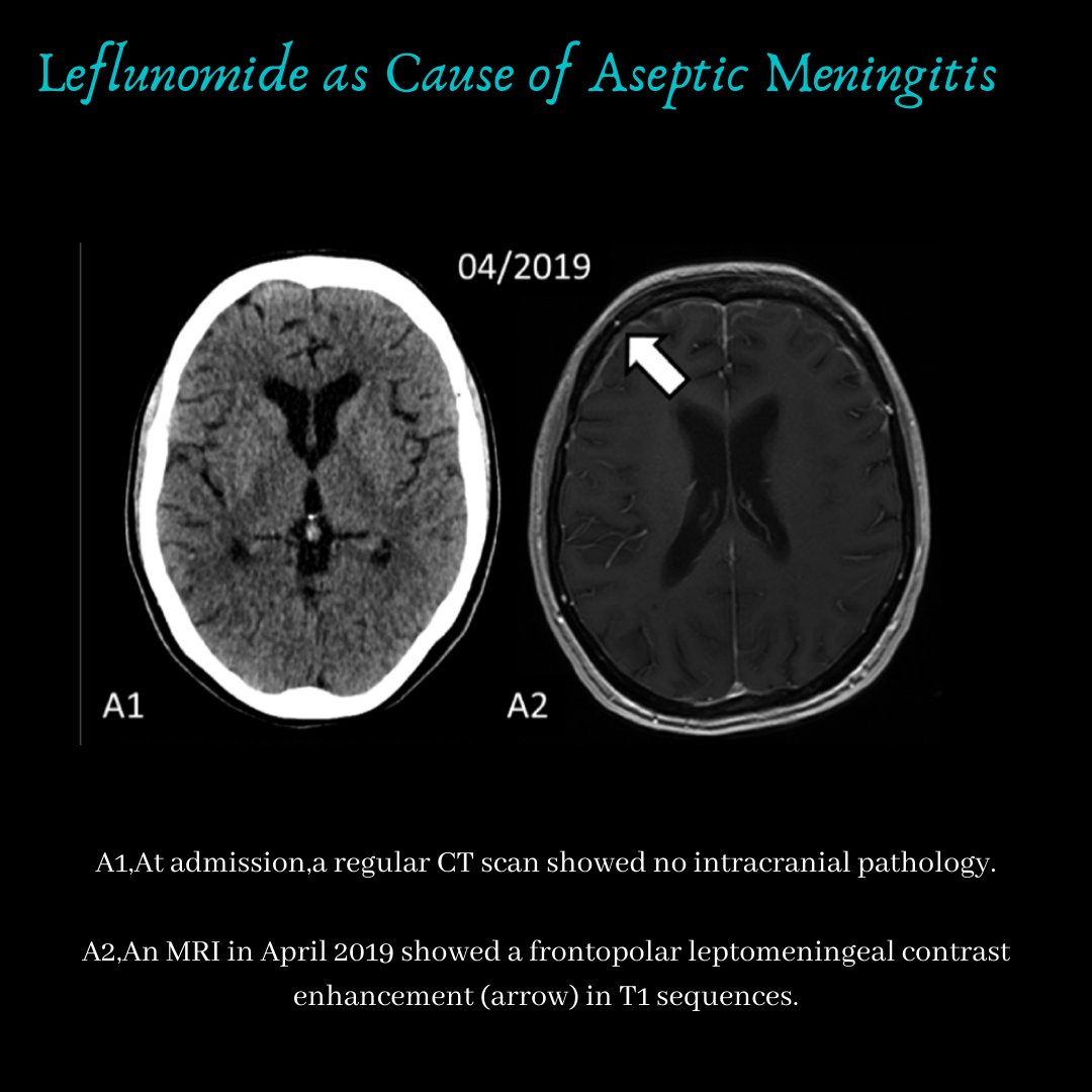 JRheumatology's tweet photo. Can #leflunomide cause #meningitis?
https://t.co/5zS94MoqNS
#drugwatch #adverseeffects #rheum #rheumatology #immunology #science #medicine https://t.co/c5ucTenuF2