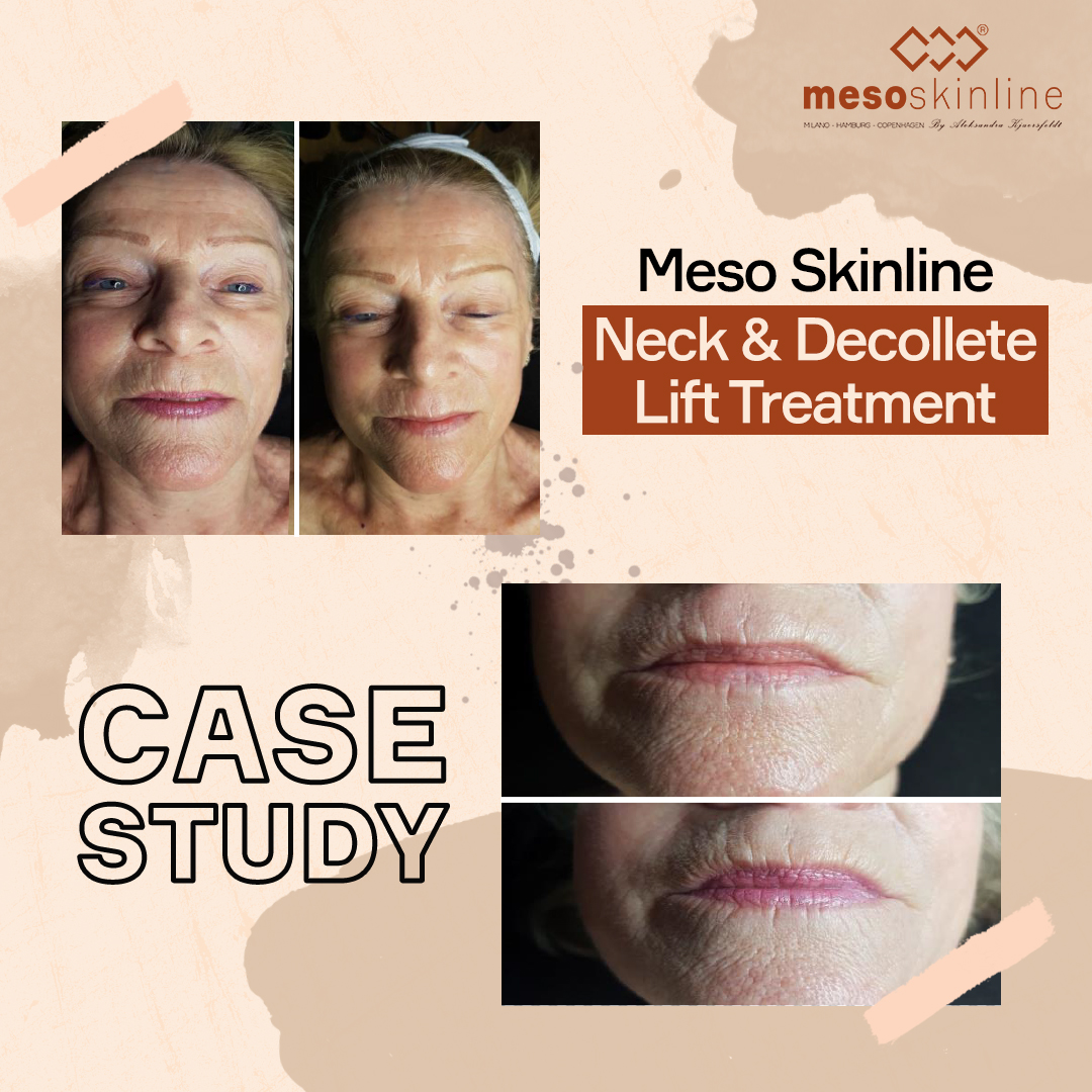 mesoskinline's tweet photo. Meso Skinline Neck &amp; Decollete Lift Treatment Case Study

Read More: https://t.co/UmSVxfHhc2

#mesotherapy #meso #beautycourse #training #face #skinrejuvenation #skincare #skin #mesoneckanddecolette #firmskin #mesoskinline #labina #mesotech #mesoskinlineworldwide #molecularweight https://t.co/1YL9rjW3CP