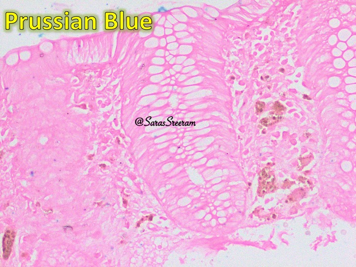SarasSreeram's tweet image. Chronically Constipated Colon #GIPath #PathTwitter