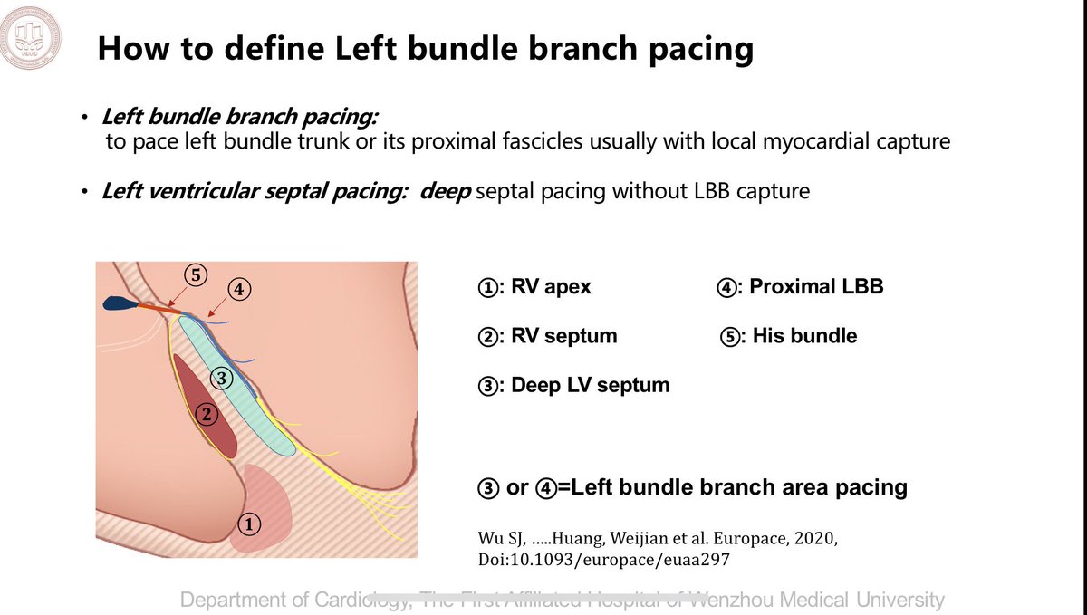 What’s the difference between LBBP and LBBAP? #dontdisthehis #EPeeps