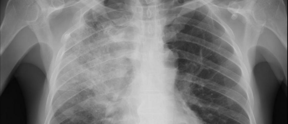 For example, medical conditions tend to be described literally:diabetes: "sugar urine disease" 糖尿病pneumonia: "lung inflammation" 肺炎asthma: "panting for air" 气喘arthritis: "critical joint inflammation" 关节炎Alzheimer’s: “confused and dull-witted in old age” 老年痴呆