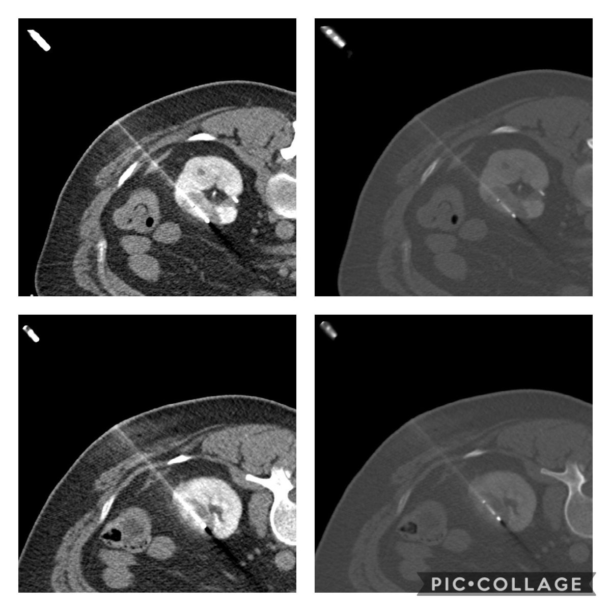 eliebalesh's tweet photo. CT-guided cryoablation of renal cell carcinoma using bracketed @bostonsci @BTGIO #IceSphere cryoprobes. #NephronSparing #IRad #Urology ๐ฅถโข๏ธ https://t.co/oYS9lCk5Fo