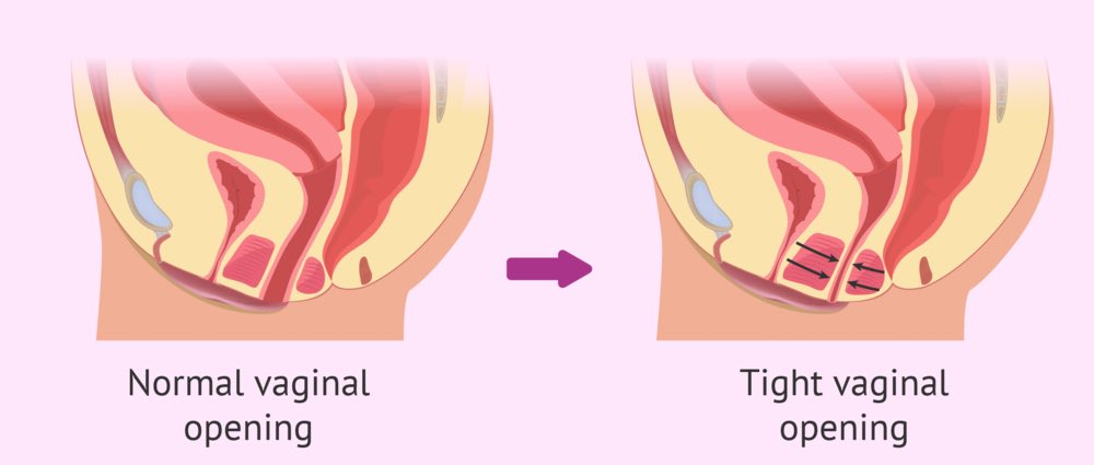 Here’s a diagram of what vaginismus kinda looks like.