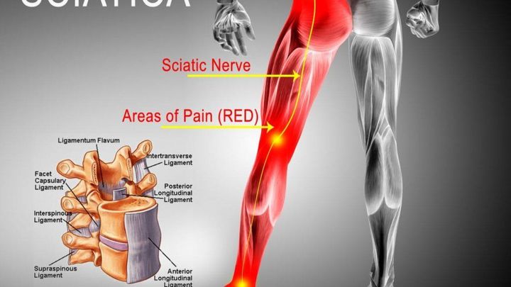 Spinal_Stenosis's tweet photo. Chronic #sciatica makes daily routines much harder. Learn more about how its treated so you can #getyourlifeback 
https://t.co/3GDxc0Qzrc
#usaspinecare https://t.co/rjFwKzw0NB
