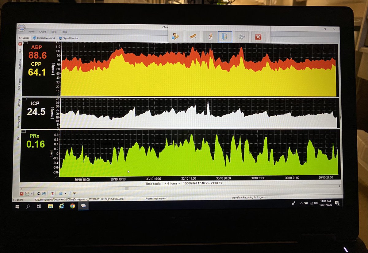 omarshahmd's tweet photo. ICM+ up and running in our NICU! Worlds better than our previous #multimodalitymonitoring setup. Much thanks to @icm_plus and @DrSmielewski. #neurocritcare #neurotwitter #criticalcare https://t.co/ngQ77zt5OD