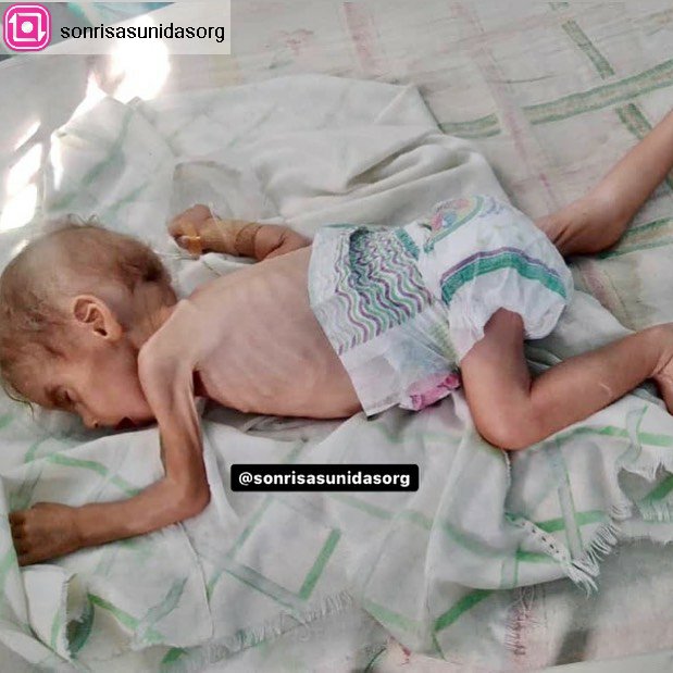 Ángel de Jesús, 8 meses, con DESNUTRICIÓN CRÓNICA 😭 pesa 3.400 kg 
Se encuentra en el Hospital José María Benítez de Aragua. 
• Requiere: Traslado en Ambulancia hacia Caracas, Estudios Médicos, Fórmula Nutramigen, Pañales, Ropa, Alimentos🙏🏻 si puedes ayudar @sonrisasunidasorg