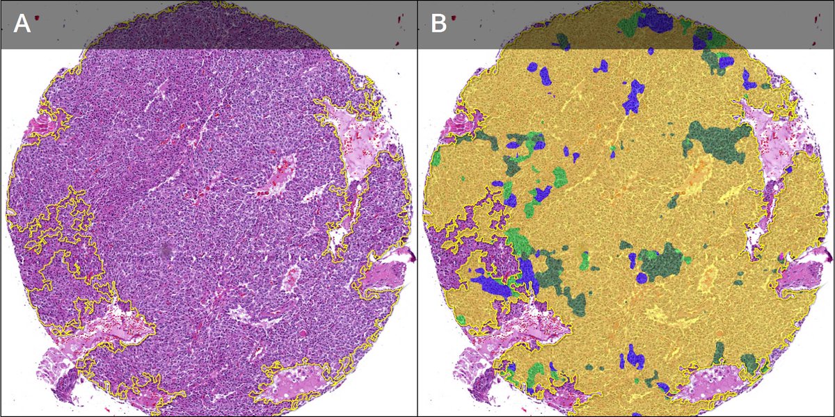 JHansonPathMD's tweet photo. Has immunohistochemistry ever let you down when trying to determine site of origin for WDNETs? Maybe AI can help? Check out our latest paper in @JPathInfo. https://t.co/LlZTiWb0Qg https://t.co/q3UXJCCwIA