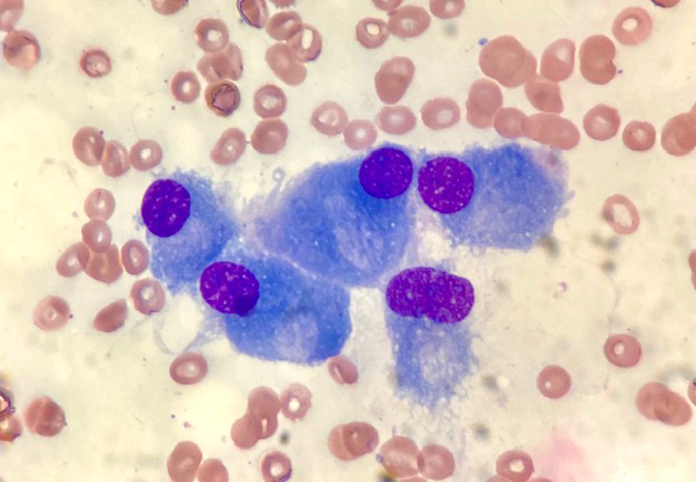 Check out these beautiful cells from a bone marrow aspirate smear!
What are they? 
📸by <a href="/AlessaAragaoMD/">Alessa Aragao, MD</a>