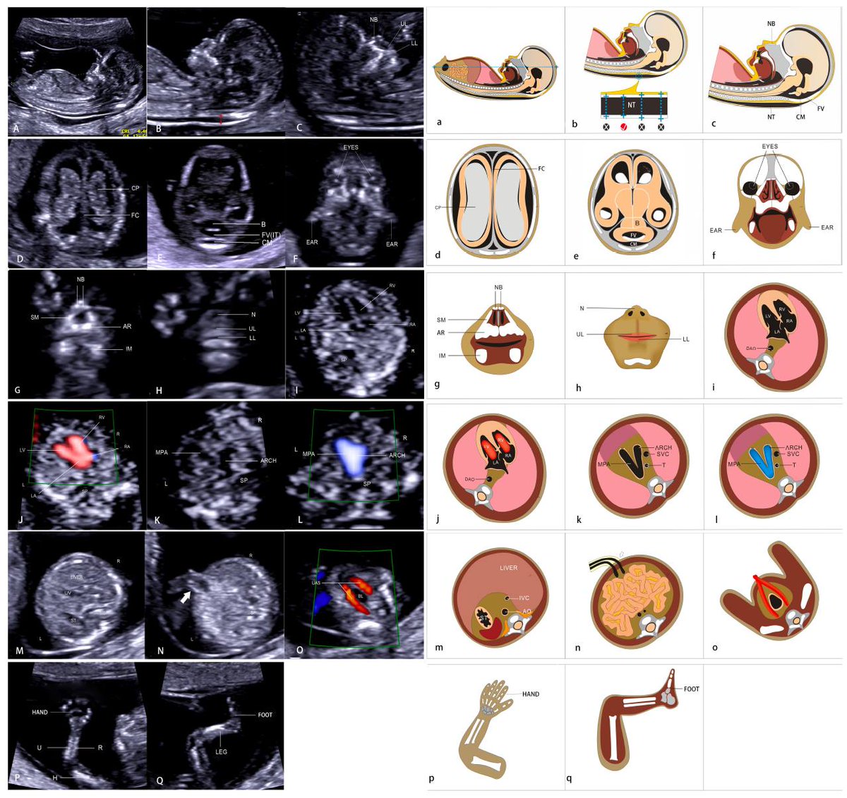 AJOG_thegray's tweet photo. Routine first-trimester #ultrasound screening using a standardized anatomical protocol https://t.co/Vuqy7RKc9y #loveultrasound https://t.co/EZ8nD2CAhm