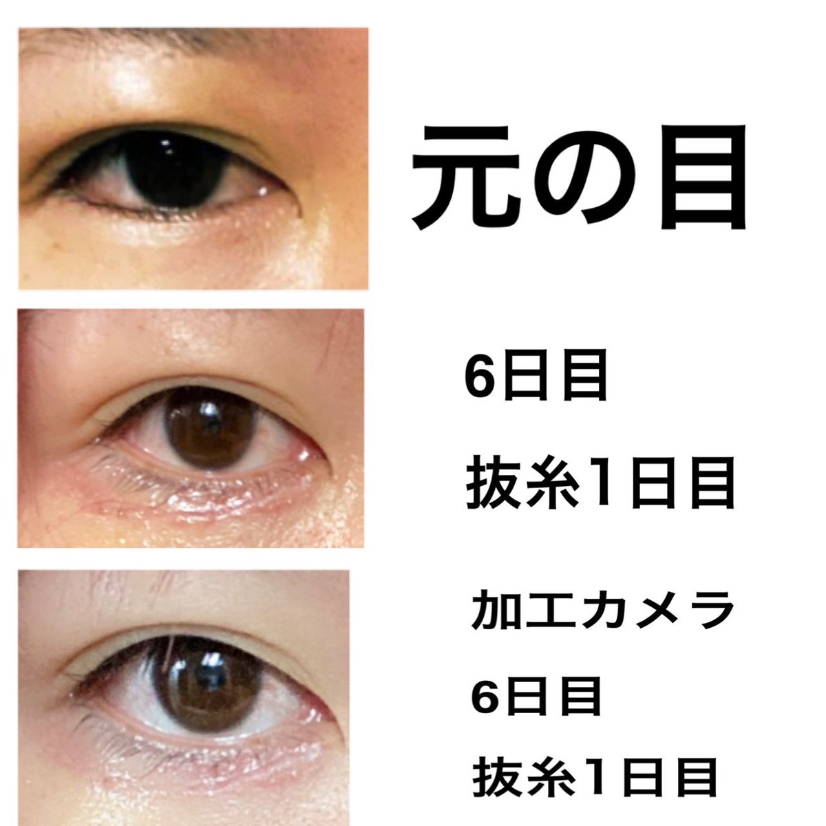 逆さまつげ手術 逆さまつげ手術