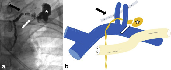 Stent Graft Reconstruction of the Lymphovenous Junction after Complete Transection of the Cervical Thoracic Duct | ow.ly/2wm750C8cba #irad <a href="/ArizonaVIR/">University of Arizona VIR</a>