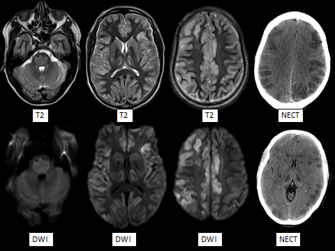 Hammerdongle's tweet photo. Dick's Pick of the Week: Osmotic Demyelination Syndrome: both pontine and extra pontine. 

Pontine and capsular involvement and globus sparing helps differentiate from anoxic injury.

#FOAMed #FOAMrad #radres #NeuroRad #radiology #Neurology https://t.co/QtAuG2qwJx
