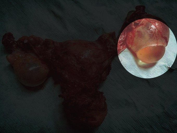 This is how a woman's womb (uterus) looks like. The surgical removal of a womb is called hysterectomy.