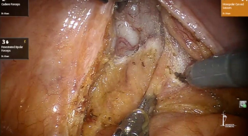 A guide to the anterior plane in robotic TME

link.springer.com/article/10.100…

free video at the link

#colorectalsurgery #colorectalresearch #SoMe4Surgery #SoMe4Trainees