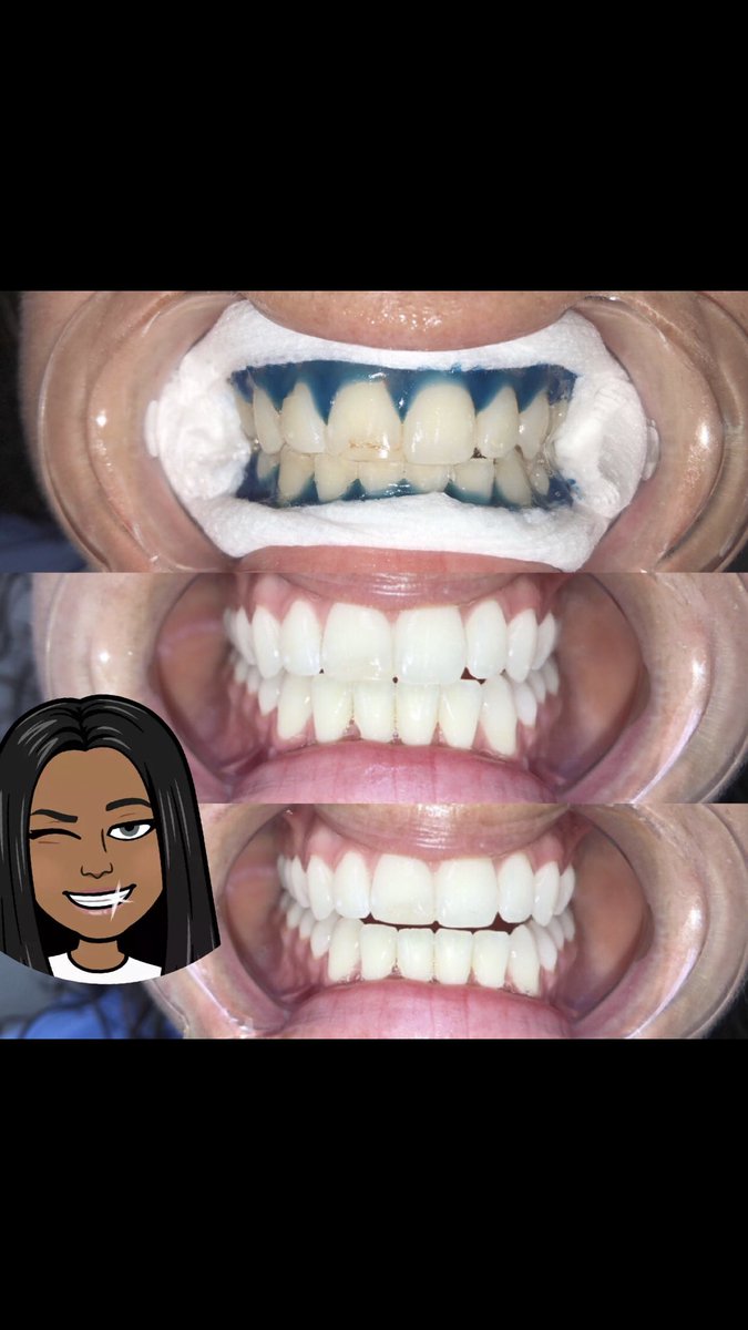MercedesLindsey's tweet photo. So I Will Be Doing A Holiday Special That Last From Today November 1st Until December 31st‼️ So Book Your Appointments Today Get You And A Loved One Teeth Whitened🤩 (*!!!Also If You Refer 3 People Your Touch-Up Will Be FREE!!!*) So Book Your Appointments Now! https://t.co/AluRSPqGdg