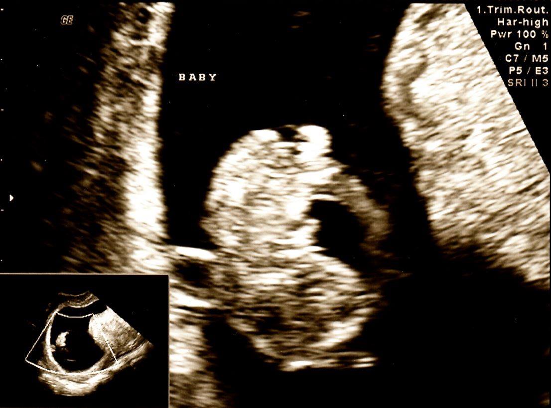 3. As a father of two delightful, intelligent, vivacious girls, I have every bit the claim on their lives that their mother does. I emphatically deny the specious, despicable "women's choice" canard. Look at Emily and Charlotte. Those are MY awesome girls, not someone's choice.