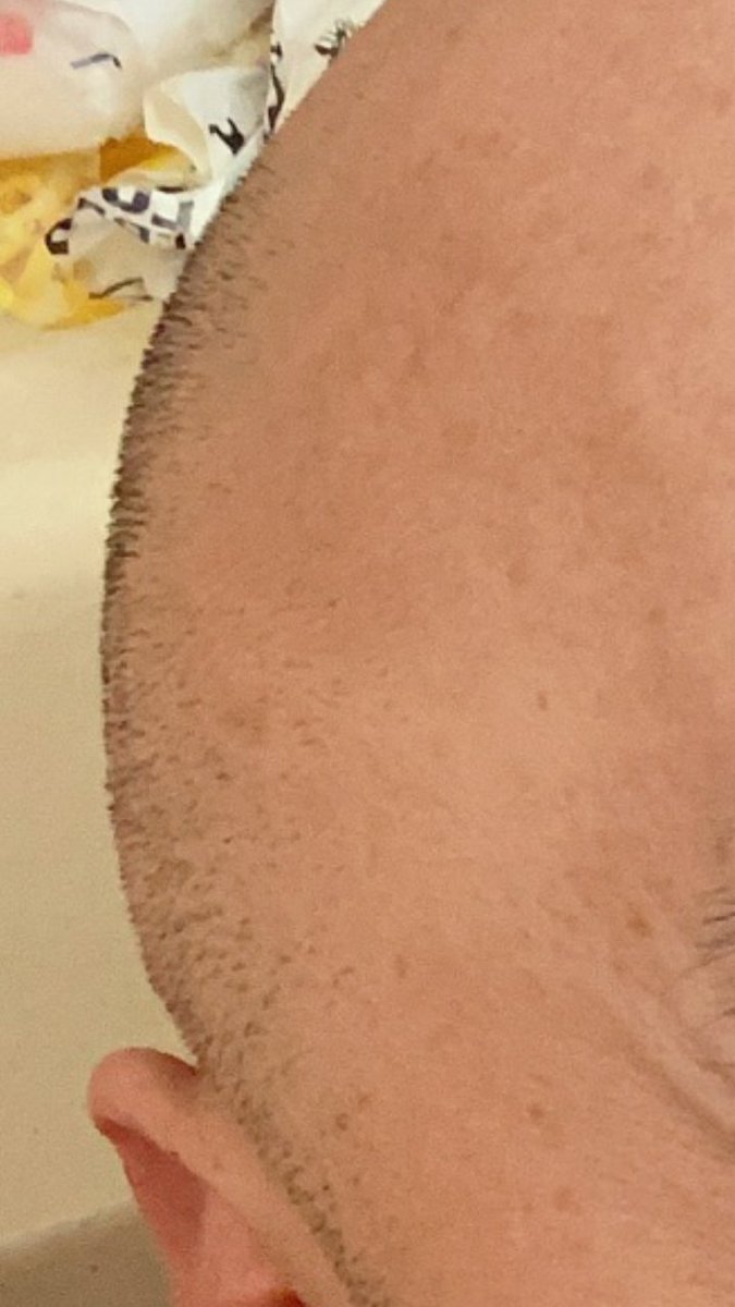 たか 剃る前の毛 前髪付近は全く毛がないしん