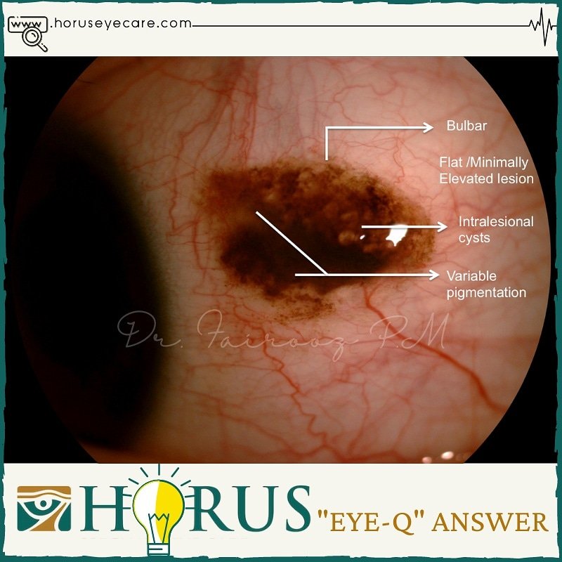 CancerEye's tweet photo. Quiz 1 Answer👇

https://t.co/7QPlJovJht https://t.co/mkoLGF6fsO