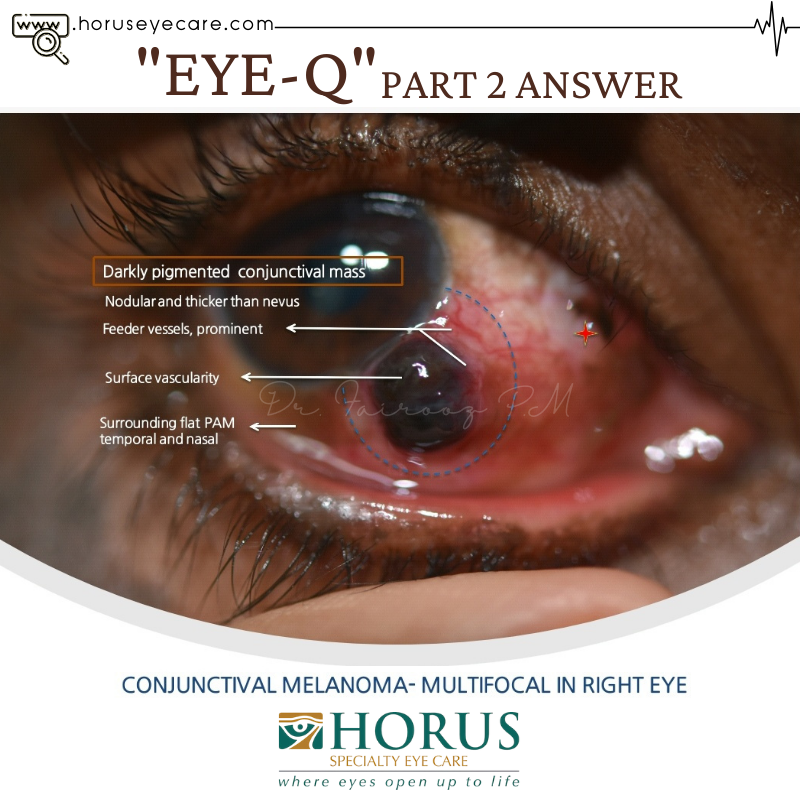 CancerEye's tweet photo. Quiz 2 Answer👇

https://t.co/Z3TjBkcfvt https://t.co/hyyhQ4d3XU