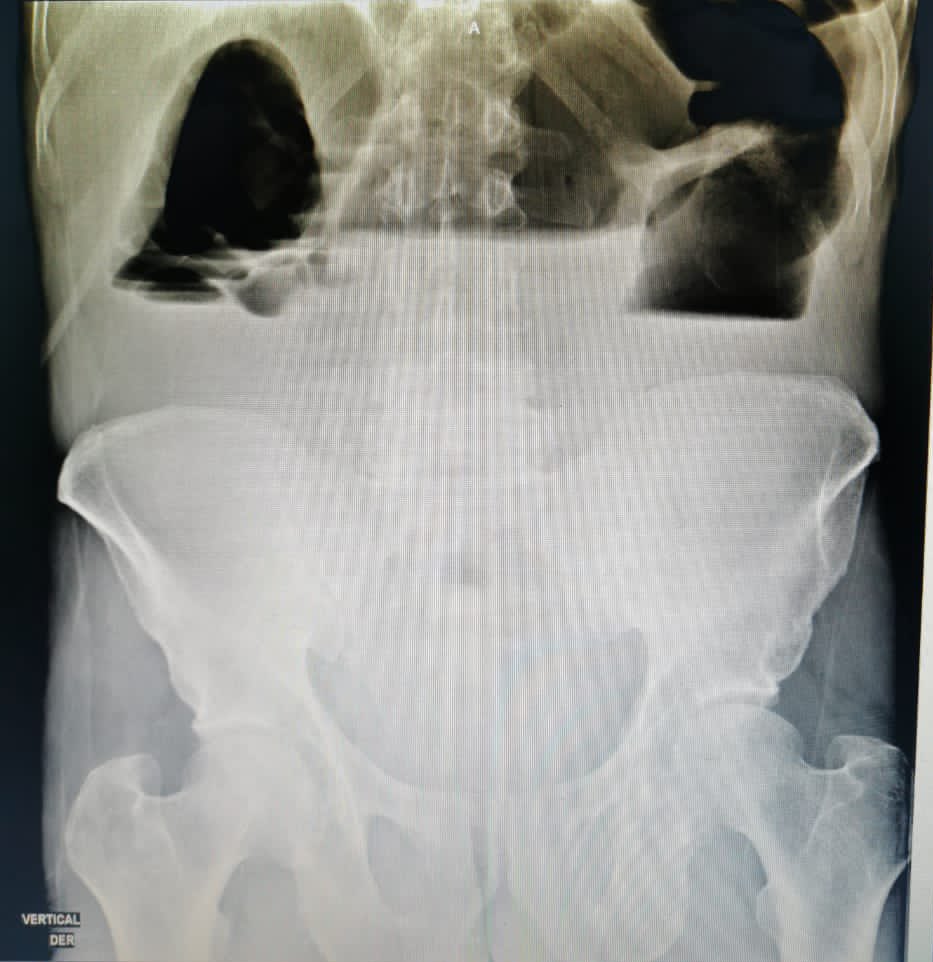 Small Bowel Obstruction: Do you still order an abdominal X-ray in the first line when you suspect a small bowel obstruction? <a href="/DrDaniloAcevedo/">Dr Danilo Acevedo</a> <a href="/PipeCabreraV/">Dr Luis Felipe Cabrera Vargas MD FACS</a> @MISIRG1 @Cirbosque <a href="/almagoch/">Alberto</a> <a href="/pferrada1/">Paula Ferrada MD FACS FCCM MAMSE</a> <a href="/CirugiaU/">Cirugía Fundamental</a> <a href="/CirugiaUdC/">Cirugía UniCartagena</a> #SoMe4Surgery #UISurgery
