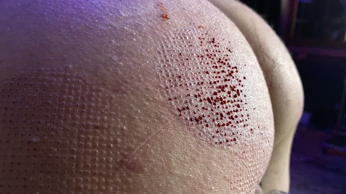 Irritated that I can&rsquo;t post blood on AVNStars, but here are some lovely textural photos from My 48hr