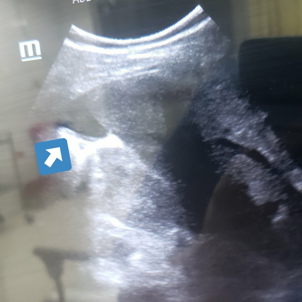 EmRad8's tweet image. FAST extendido, liquido libre, trauma hepático grado 3, trauma renal y hematoma Retro peritoneal. 
ingreso rápido a quirofano con diagnóstico ecografico Pocus