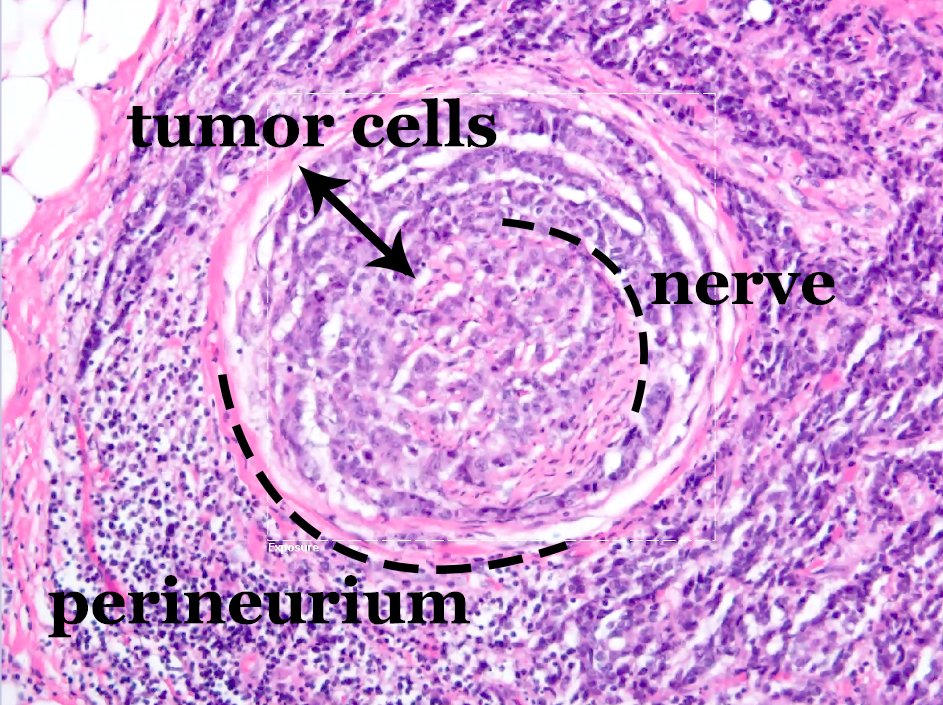 DamianGrybowski's tweet photo. Perineural invasion (PNI) - growing tumor follows the way of least resistance in the perineural space. It happens in prostate cancer, which recently was the focus of my studies. #pathelective #loyolapathology @KMirza https://t.co/92oPiJ7sKC