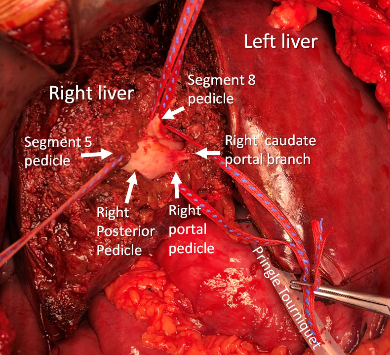 SoCalYuman's tweet image. No real reason to do it blind. Picture of recent resection I did with @CamilleLStewart. Can find any segmental pedicle in liver for parenchymal-preserving tailored resection. Working on AI methods of finding pedicles. #MoreCuresLessInvasive @CityofHopeSurg @cityofhope